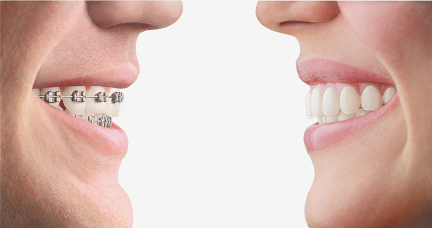 A Clear Alternative For A Straighter Smile – Invisalign in Waterloo