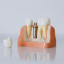 Dental Implants – A Game Changer