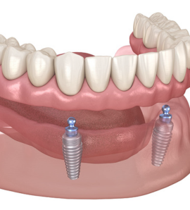 dental-implants-waterloo